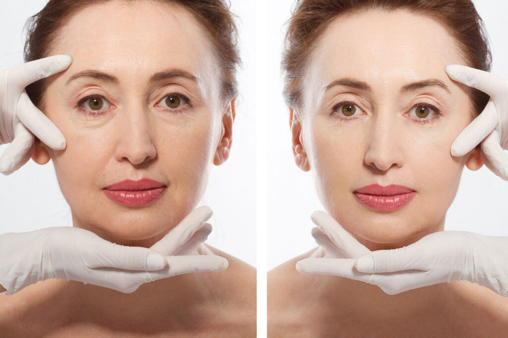 Eyelid Surgery 